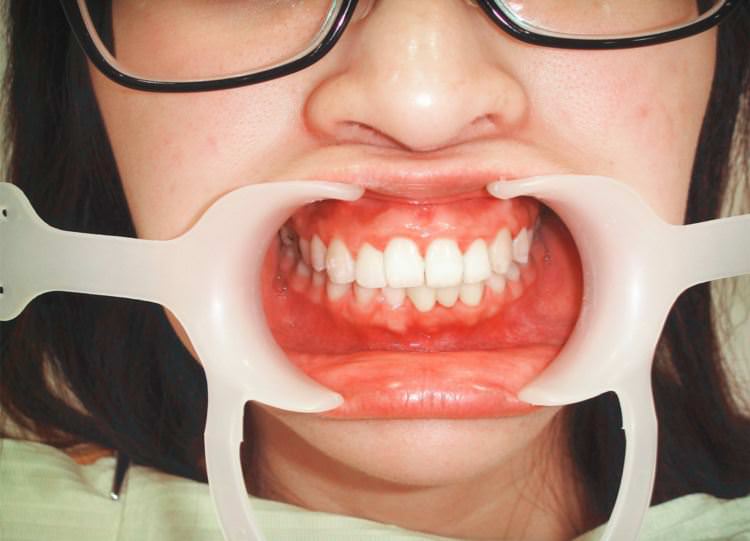 美容牙科,3D齒雕,一日植牙,植牙專科,竹北真美牙醫診所