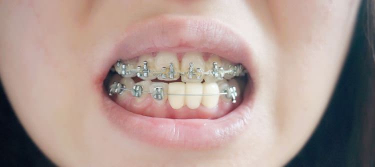 美容牙科,3D齒雕,一日植牙,植牙專科,竹北真美牙醫診所